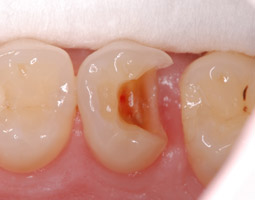 inlays-dentiste-rouen