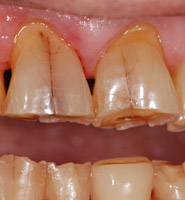 prothese-dentaire-rouen2