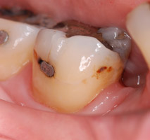 prothese-dentaire-rouen1