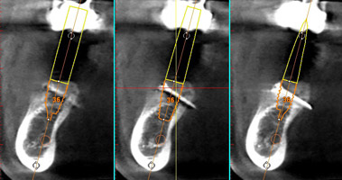 implant-dentaire-forges-les-eaux1