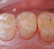 inlays-dentiste-rouen3