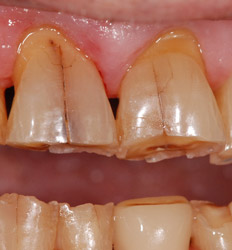 fracture-dentaire-rouen1