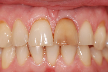 fracture-dentaire-rouen3