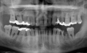 cas-4-histoire-de-maladie-parodontale-av--300x183