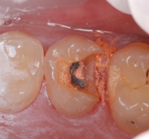 inlays-dentiste-rouen2