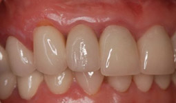 implants-dentaires-forge-les-eaux1