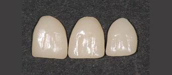 facettes-dentaires-miniere1